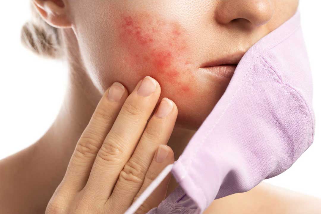 You are currently viewing How to treat Acne the fast and easy way